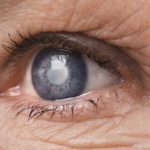 Glaucoma cause e rimedi antiossidanti contro l'azione dei radicali liberi