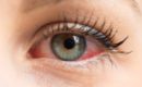 Occhio secco e rosso: quando i metalli pesanti sono la causa principale